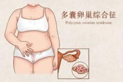 多囊卵巢綜合征難懷孕嗎?多囊卵巢的卵泡一般有多大?