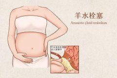 羊水栓塞是什么意思？是什么原因導致的？