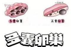 多囊卵巢生化妊娠后容易懷孕嗎？多囊懷孕容易流產的原因？