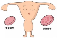 多囊卵巢綜合癥是怎么回事？多囊卵巢綜合癥能做試管嬰兒嗎？