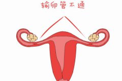 輸卵管輕度粘連會懷孕嗎？輸卵管粘連可以要孩子嗎？