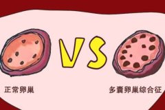 多囊卵巢綜合癥對生育的影響：了解并克服障礙，實現懷孕夢想
