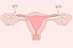 雙側輸卵管結扎后還能復扎嗎？詳解手術流程與注意事項