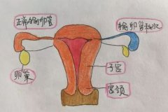 輸卵管積水會影響排卵嗎？輸卵管積水影響試管移植嗎？